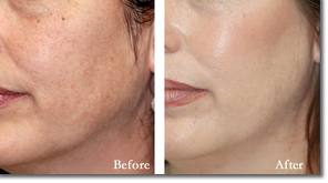 ChemicalPeel-BA-img