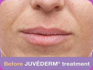 Juvederam-BA-img