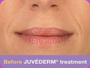 Juvederam-BA-img3