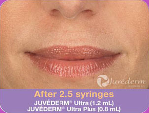 Juvederam-BA-img4