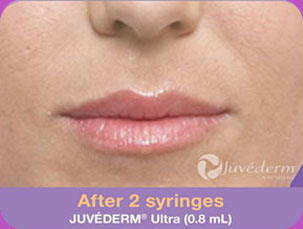 Juvederm-BA-img2