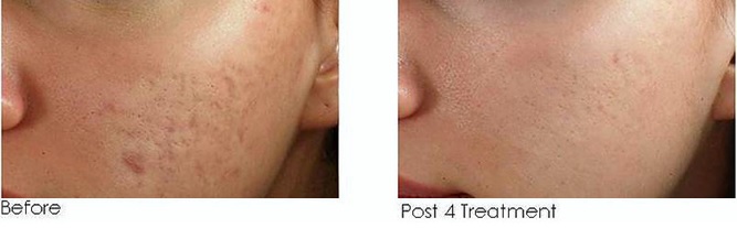Micr-needling-half-2