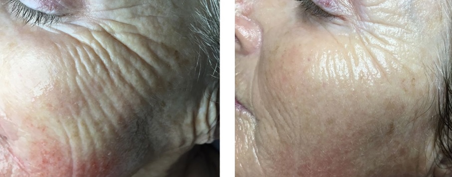 Micr-needling-half-3