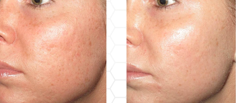 Micr-needling-half-4