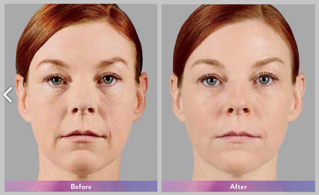 43Voluma before after