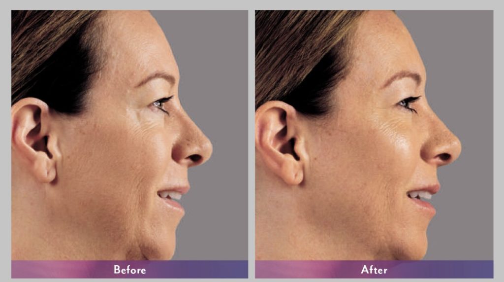 44Voluma Befor after