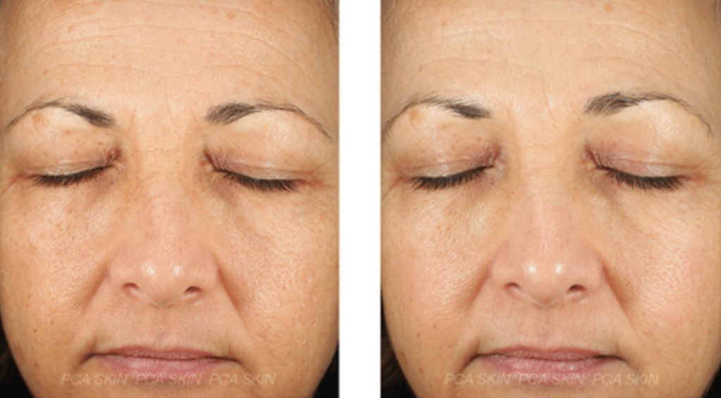 #49 Chemical Peel befor after